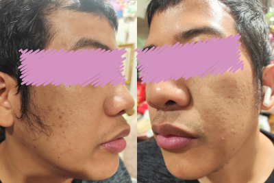 魔法のオールインワン石鹸を使用する前の男性の肌の様子