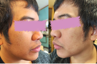 魔法のオールインワン石鹸を10日間使用した後の男性の肌。ツヤが出て清潔感がアップした状態