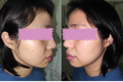 魔法のオールインワン石鹸を使用する前の女性の小鼻・毛穴の状態