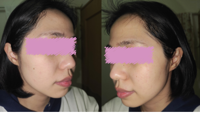 魔法のオールインワン石鹸を10日間使用した後の女性の肌。毛穴汚れがすっきりし、なめらかになった様子